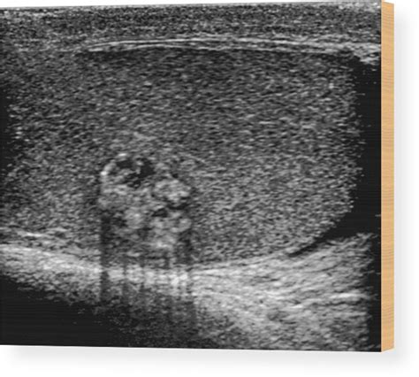 Testicular Cancer Ultrasound Scan Wood Print By Du Cane Medical