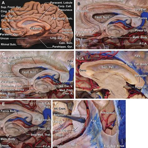 Corpus Callosotomy The Neurosurgical Atlas By Aaron Cohen Gadol Md