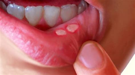 Why Mouth Ulcer Occur Causes Symptoms And Treatmentمنہ میں چھالے کیوں