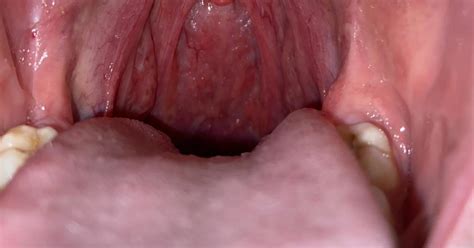Small Bump In Back Of Throat Findatopdoc