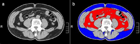 Measurement Of Intra Abdominal Fat Area By Use Of Multidetector Ct A
