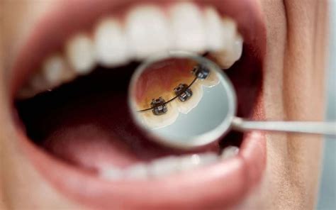Lingual Braces Differ Traditional In Teeth Straightening