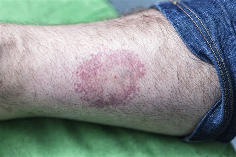 Signs And Symptoms Of Untreated Lyme Disease Health Beat
