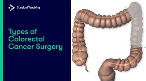 Types Of Colorectal Cancer Surgery What Are The Different Operations We Can Perform Youtube