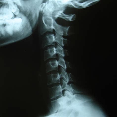 La rectificación cervical consiste en la pérdida de la lordosis fisiológica (curvatura natural) de esta región de la columna. Rectificación cervical