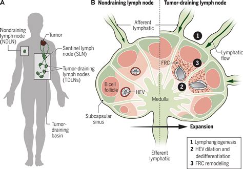 Tumor Draining Lymph Nodes At The Crossroads Of Metastasis And Immunity Science Immunology