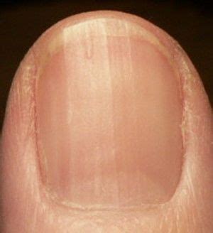 Check with your health care provider about how much you need to take, how often you need to take it. Vitamin B12 and Fingernails | Health Boundaries ...