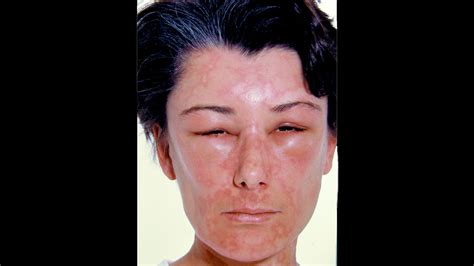 Food Allergy Symptoms On Face