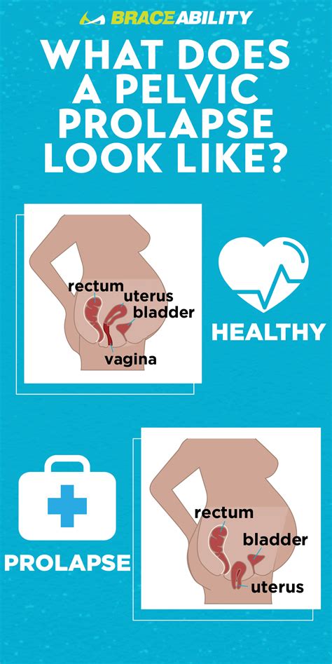 Going From Prolapse To Powerful The Complete Guide To Uterine Prolapse In 2021 Bladder