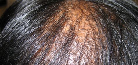It may cause enlarged lymph nodes in the chest (which can be seen on a chest x ray), skin lesions, and eye swelling or redness. Central Centrifugal Cicatricial Alopecia - MDhairmixtress.com