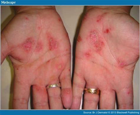 Severe Eczema On Hands Pictures Photos