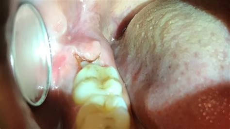 Painful Swollen Gum Around Wisdom Tooth Molar Pericoronitis Cure