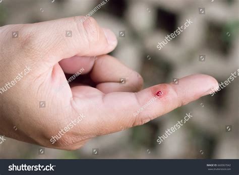 Bleeding Wound On Finger Stock Photo Edit Now 660067042