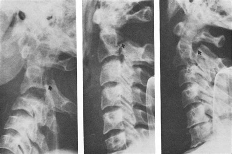 Avulsion Fracture Cervical Spine