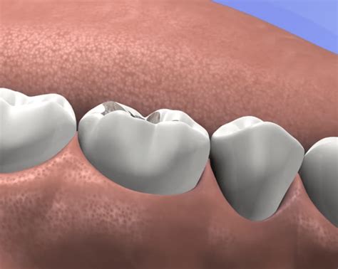 Inlays Or Onlays Stonehill Dental Hamilton Dentist