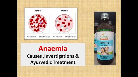 Anaemia L Causes L Investigations L Ayurvedic Prescriptions L Ayurveda Ayurvedictreatment