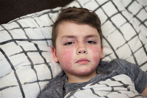 Scarlet Fever What Is Causes Symptoms And Treatment February