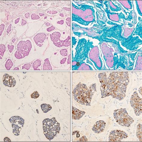 Histopathological Findings Of The Primary Mucinous Carcinoma Of The