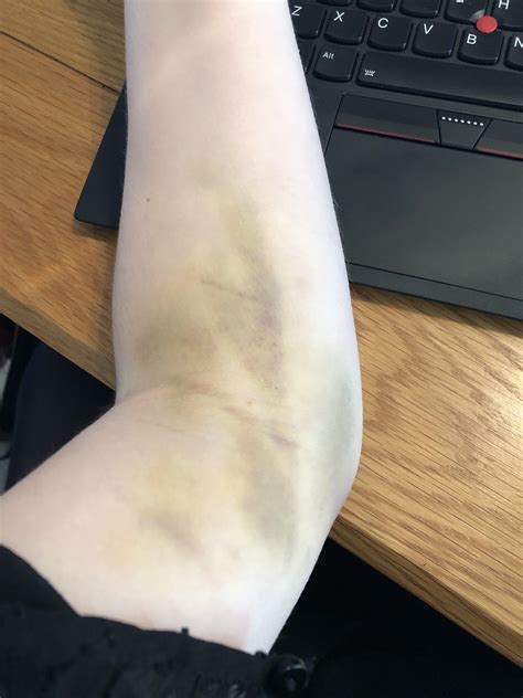 A person can take acetaminophen, but they should avoid ibuprofen and aspirin for 24 hours trusted. Bruising after blood test? (It's been a week since I had ...