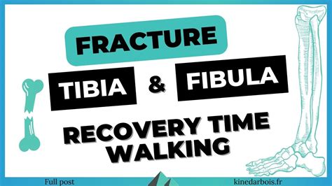 Walking After Broken Tibia And Fibula Physiotips For Recovery