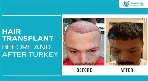 Hair Transplant Before And After Turkey Hair Transplant Istanbul
