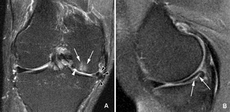 Prevalence Of Abnormalities In Knees Detected By Mri In Adults Without