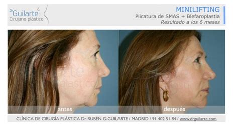 Minilifting Facial Y Cervical Para Cuello Precios Madrid Clinica Dr