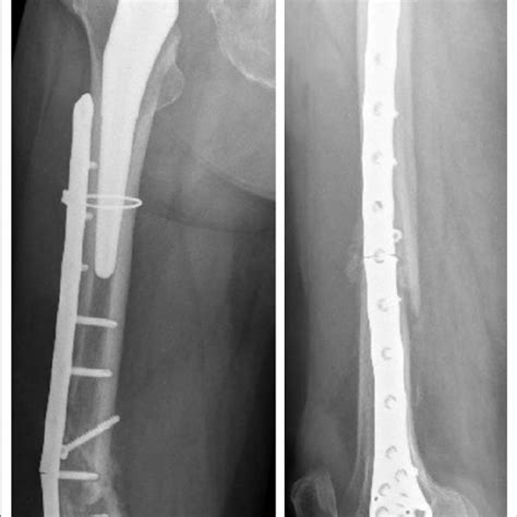Provisional Reduction Of The Femur Undertaken With Dall Miles Cable