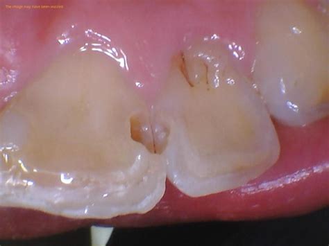 Cavity On Front Tooth Guide 1311 Jackson Ave Dental Dentist In