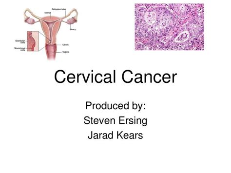 Ppt Cervical Cancer Powerpoint Presentation Free Download Id4099365