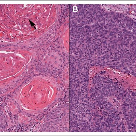 A Classic Keratinizing Invasive Squamous Cell Carcinoma Showing