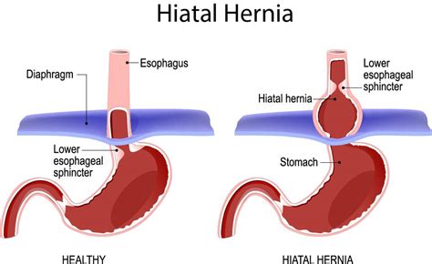 If you want to learn about the disease, you must go through the pictures carefully. Heartburn - Surgical Healing Arts Center