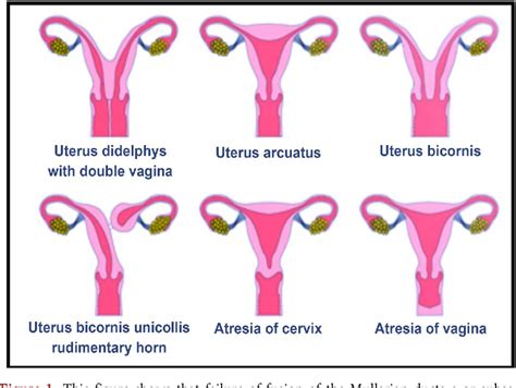 Figure From Uterine Didelphys In A Pregnant Mother Semantic Scholar