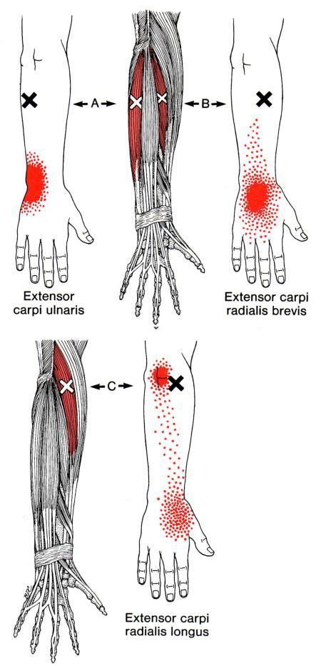 Extensor Carpi Radialis Longus The Trigger Point And Referred Pain