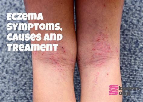 Eczema Symptoms Causes Treatment Singapore Soap Supplies