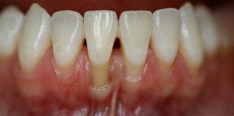 Gum Grafting Palm Desert Ca Dental Implant Dentistry Palm Desert Ca