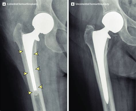 Bipolar Hemiarthroplasty Vs Total Hip Replacement