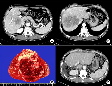 Images Of Patient 3 A B Initial Liver Dynamic Ct Scan Showing A