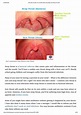 PPT - Ultimate Guide To Combat Warning Signs Of Strep Throat PowerPoint ...