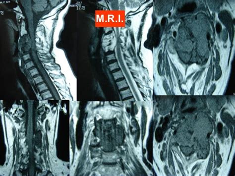 Malignant Cervical Vspine Tumorsv Operative Treatment