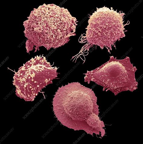 Cells From The Most Common Female Cancers Sem Stock Image C030
