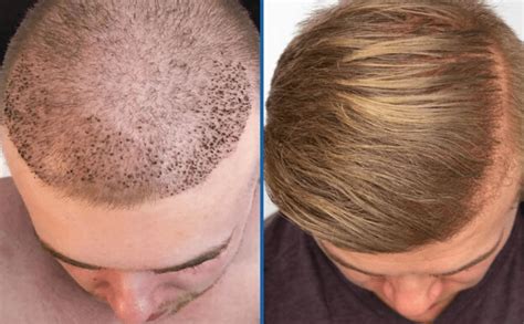 Hair Transplant The Best And Newest Hair Transplant Method Cost 890