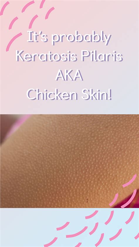 What Is Keratosis Pilaris How To Treat It And Get Rid Of It
