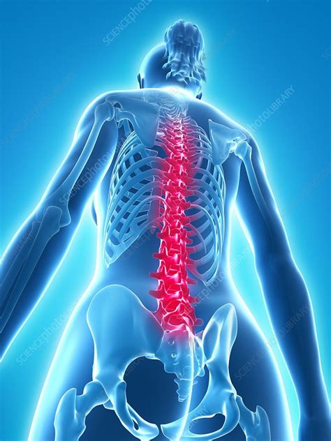 Back Pain Conceptual Artwork Stock Image F0062877 Science Photo