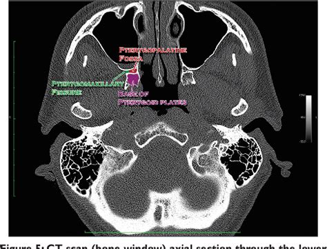 Pterygopalatine Fossa Mri