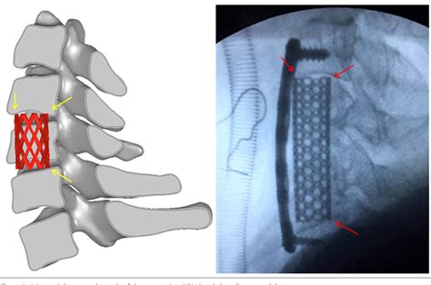 Figure 2 From Single Level Anterior Cervical Corpectomy And Fusion