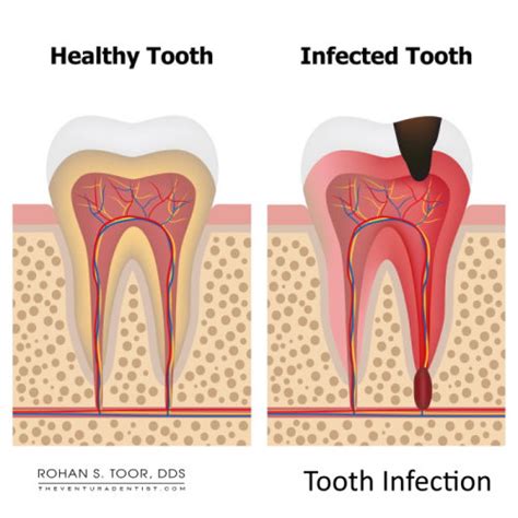 Tooth Infection Abscessed Tooth Pain Relief Causes Emergency