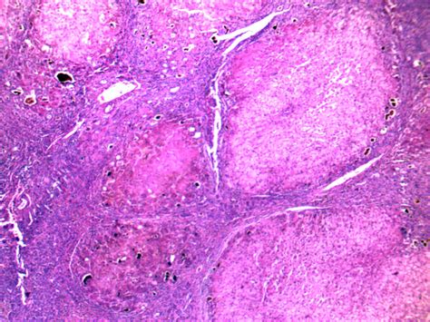 Liver Cirrhosis Prepared Slides Of Human Pathology Xinxiang Happy