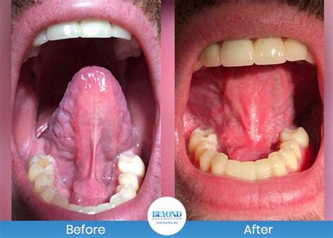 Tongue Tie Surgery Before And After Gallery In Dallas Tx