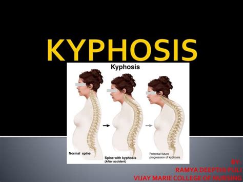 Kyphosis Lordosis Ppt